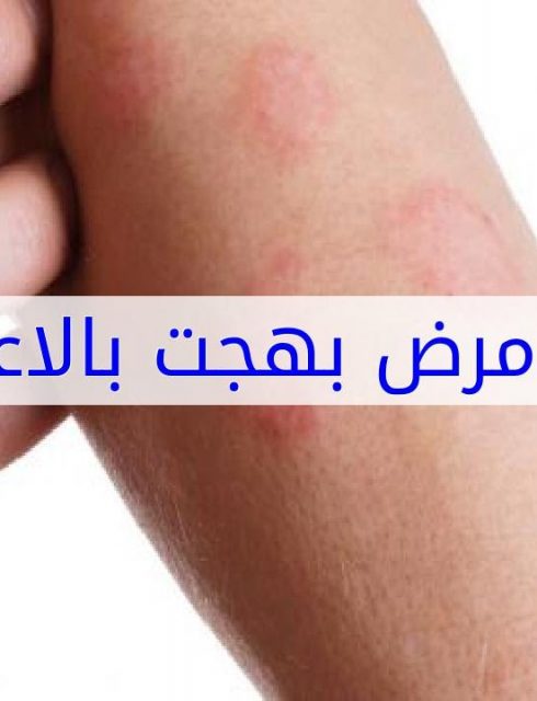 علاج مرض بهجت بالأعشاب