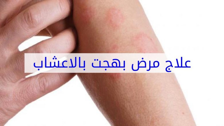 علاج مرض بهجت بالأعشاب