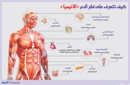 علاج فقر الدم